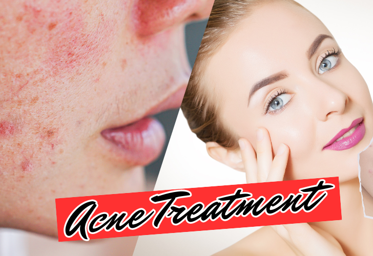 best acne treatment for teens and adults