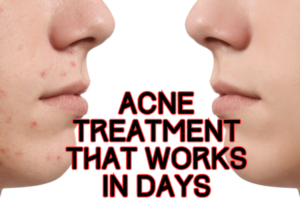 remove acne at home an illustration
